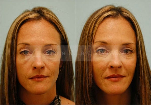 lip reduction