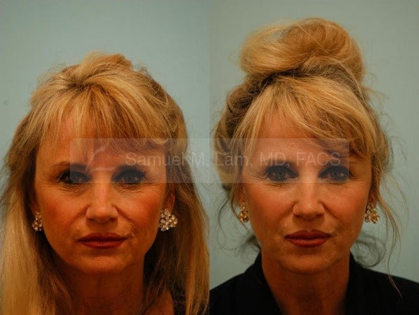 jaw reduction