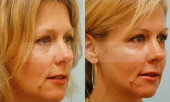 lip reduction