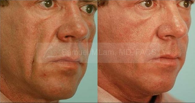 lip reduction