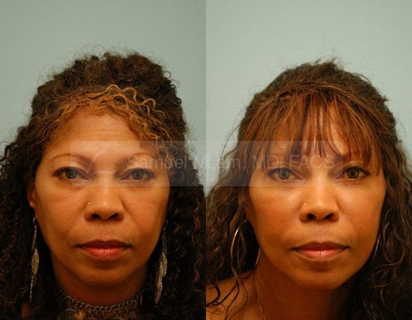 lip reduction