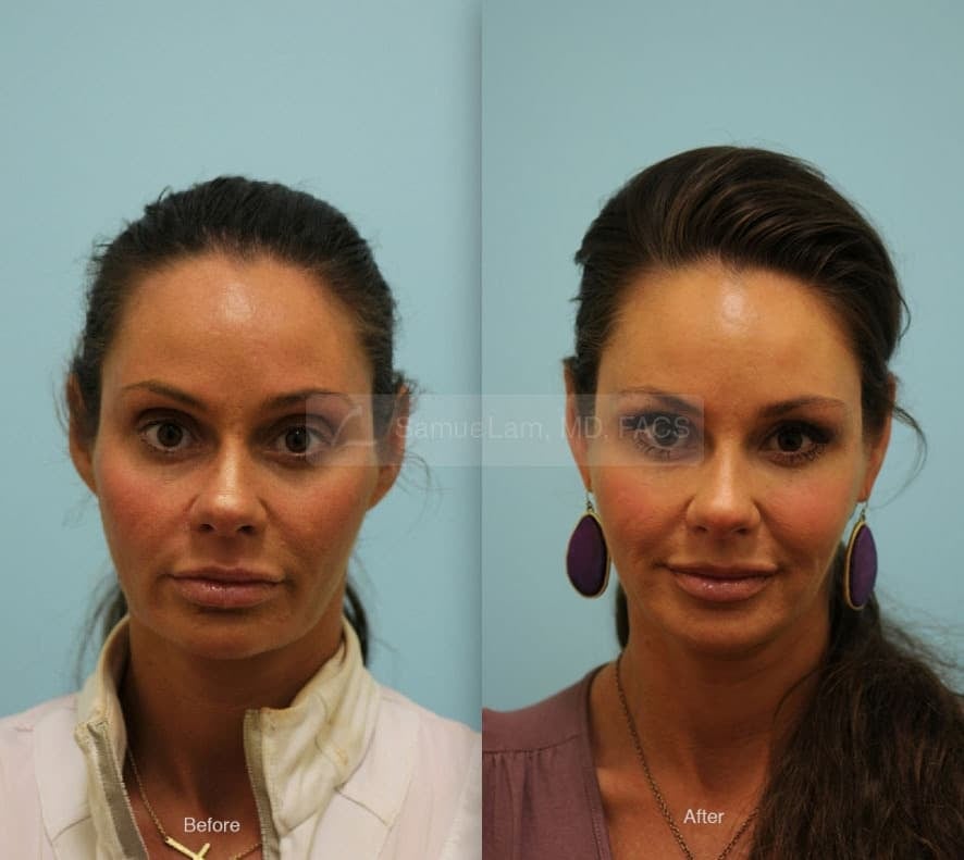 lip reduction
