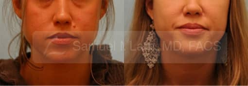 Skin Lesions / Mole Removal Photos