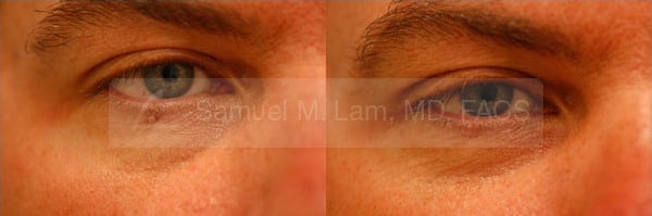 Skin Lesions / Mole Removal Photos