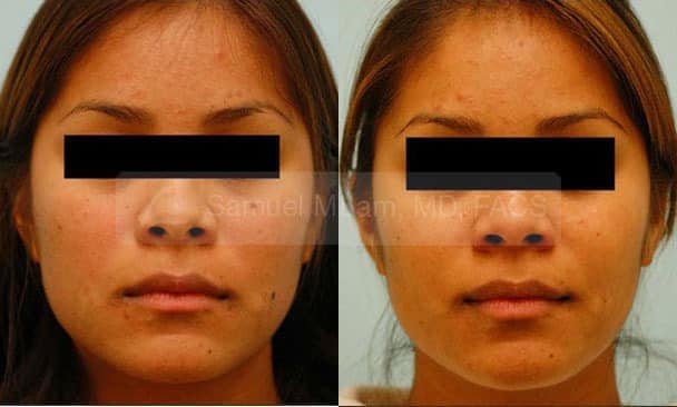Skin Lesions / Mole Removal Photos
