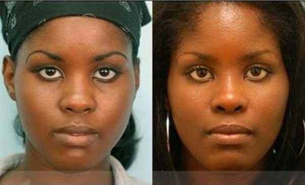 Aging Nose Rhinoplasty Photos