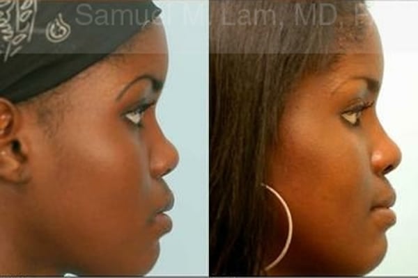 Aging Nose Rhinoplasty Photos