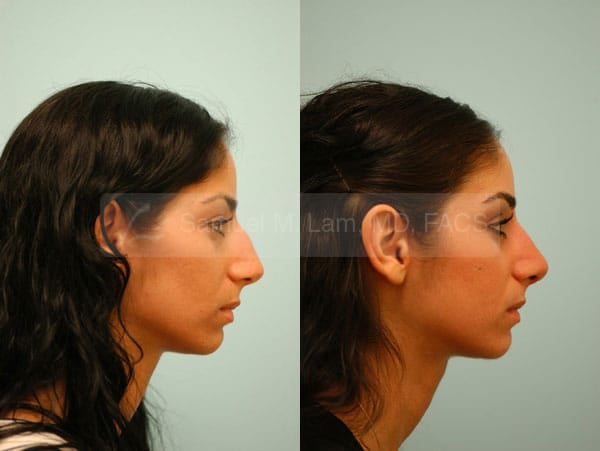 asian nose job