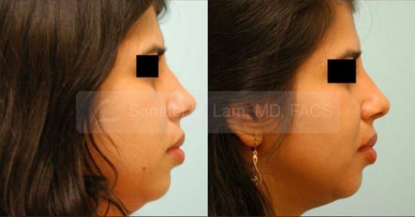 jaw reduction
