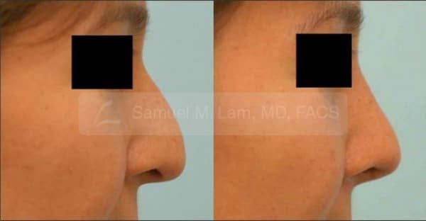 lip reduction