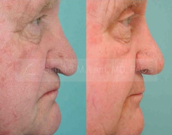 lip reduction