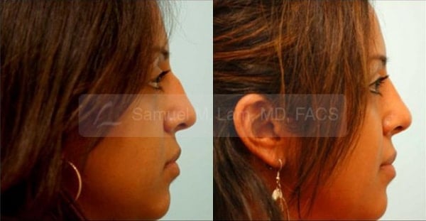 jaw reduction