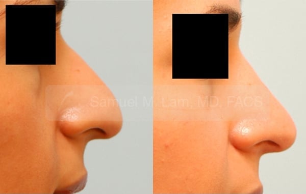 jaw reduction