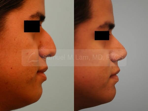 lip reduction