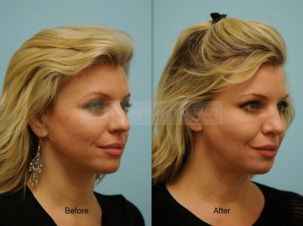 lip reduction