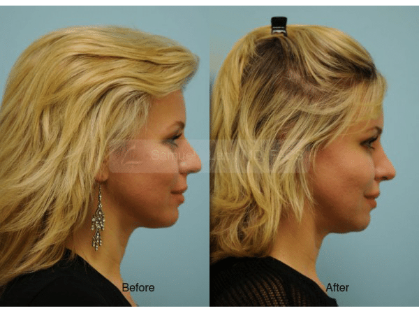 lip reduction