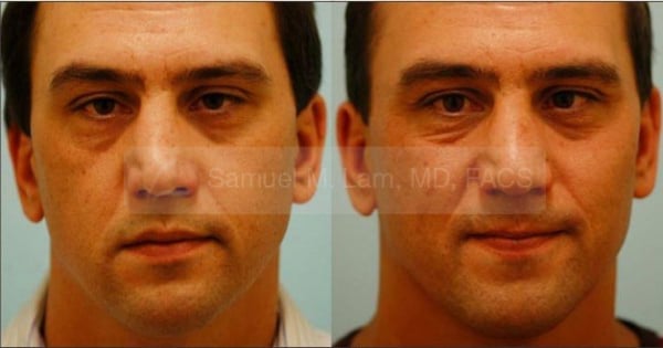 lip reduction
