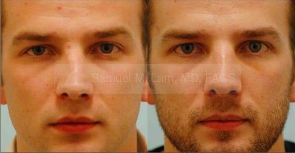 lip reduction