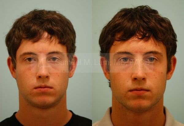 lip reduction