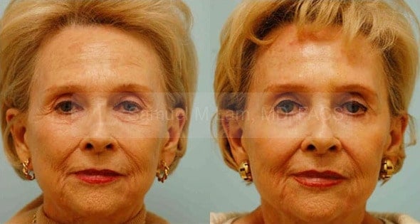 Skin Resurfacing Photos