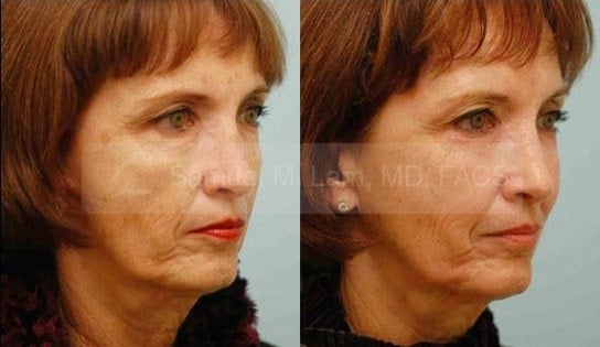 Skin Resurfacing Photos