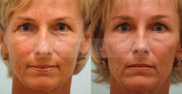 Skin Resurfacing Photos