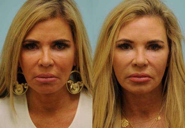 Skin Resurfacing Photos