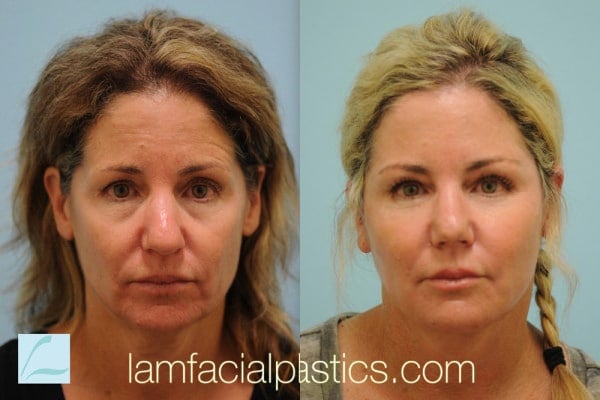 Skin Resurfacing Photos