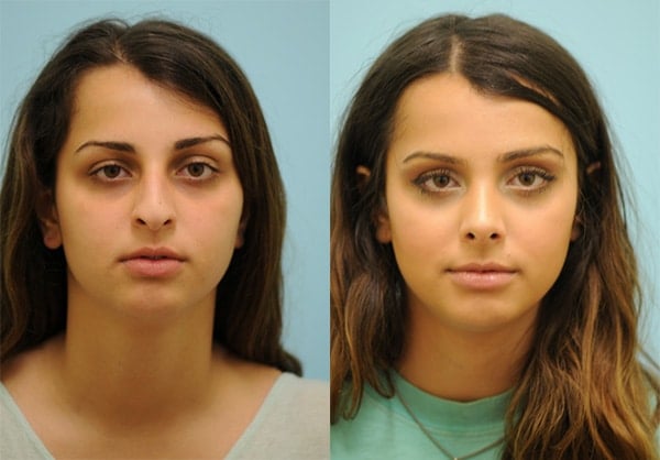 asian nose job