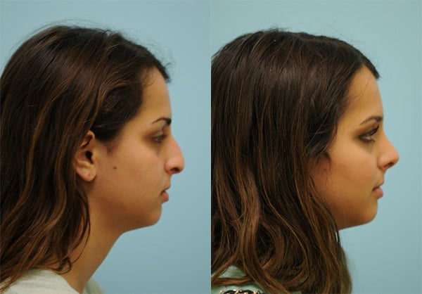lip reduction