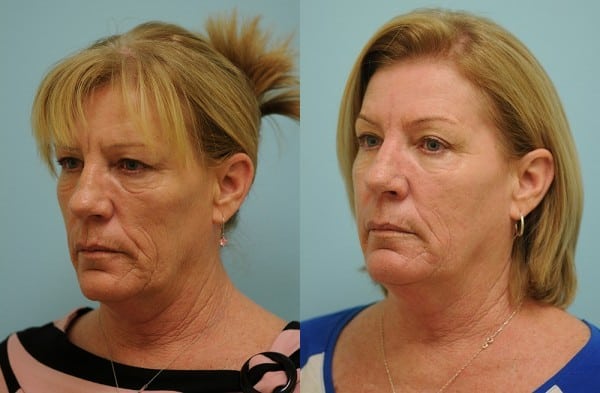 Skin Resurfacing Photos