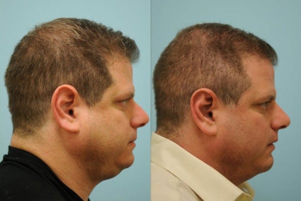 jaw reduction