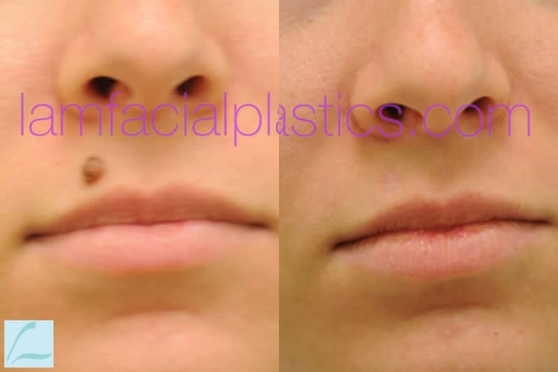 Skin Lesions / Mole Removal Photos