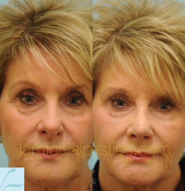 Aging Nose Rhinoplasty Photos