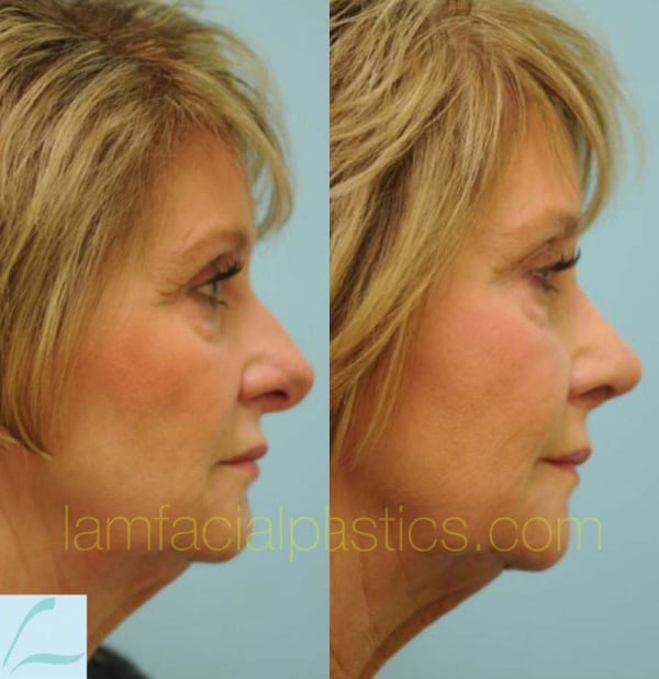 Aging Nose Rhinoplasty Photos