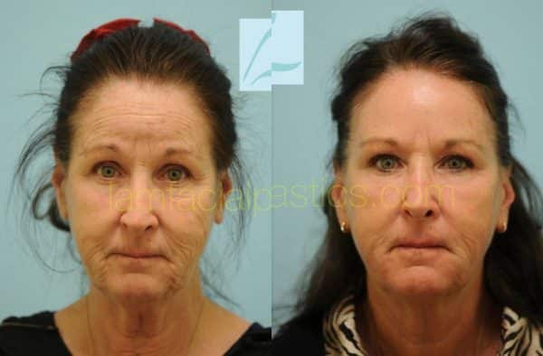 Skin Resurfacing Photos