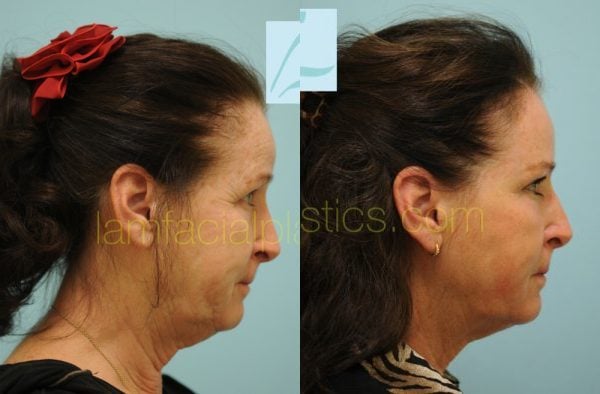 Skin Resurfacing Photos