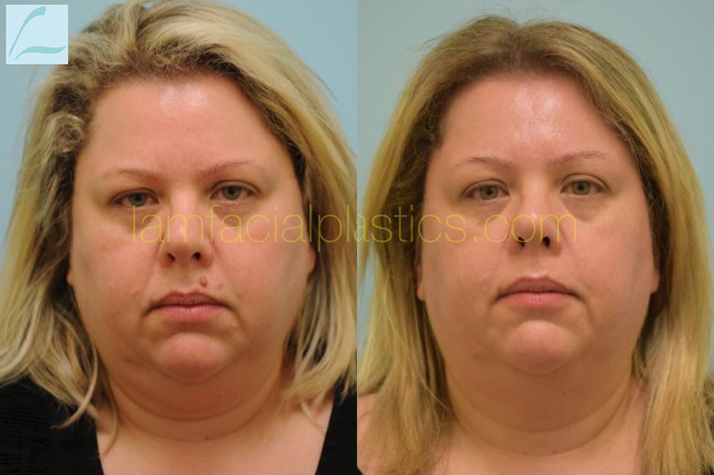 Skin Lesions / Mole Removal Photos