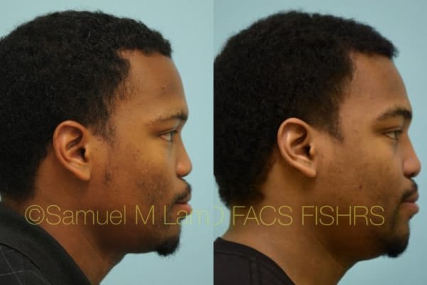 jaw reduction