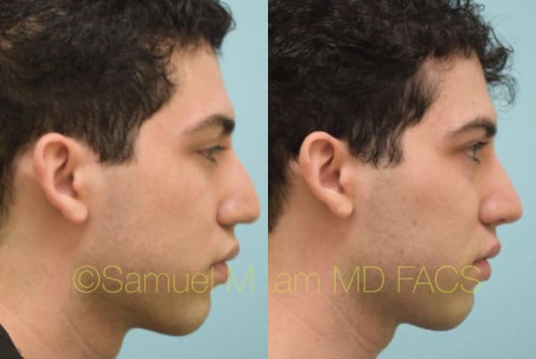 jaw reduction