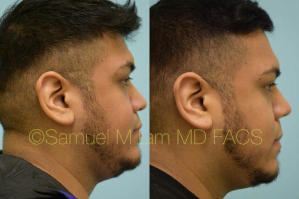 asian nose job