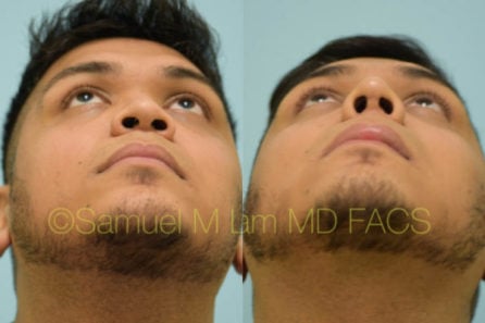 21379-08of08 Nasal Tip Rhinoplasty Result Dallas