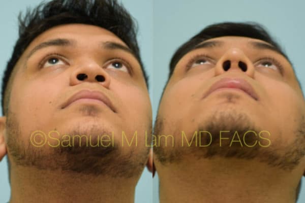 lip reduction