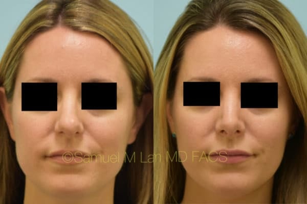 asian nose job