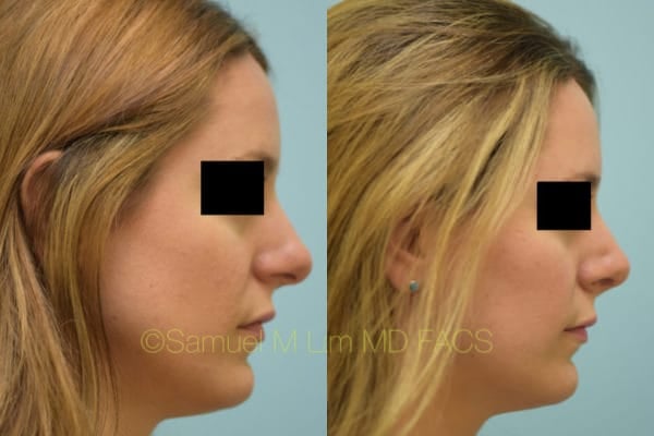lip reduction