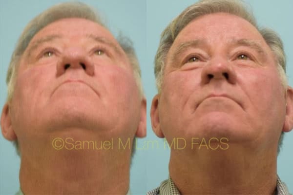 Aging Nose Rhinoplasty Photos