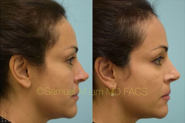 asian nose job