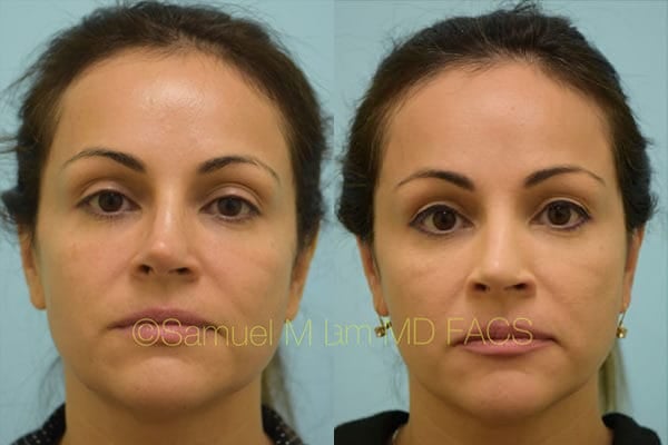 jaw reduction