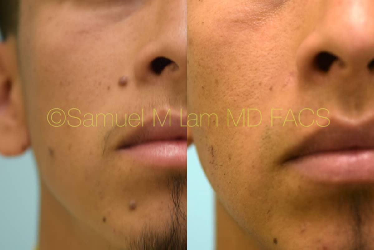 Skin Lesions / Mole Removal Photos