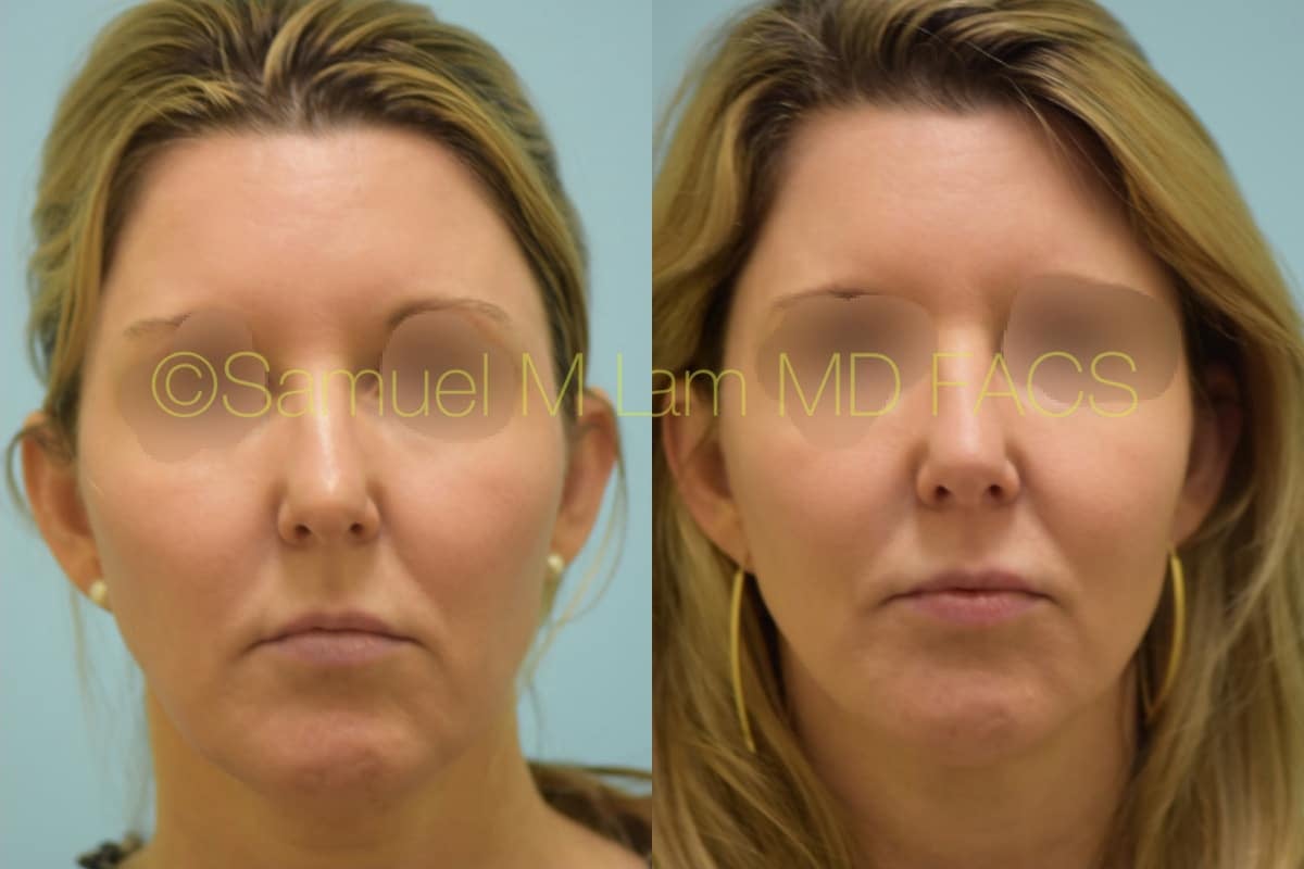 lip reduction